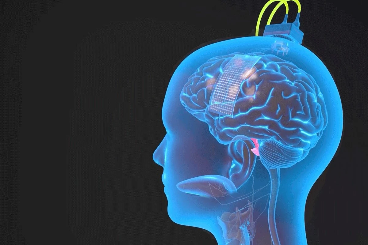 Elektrody wszczepione do mózgu